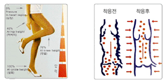 압박스타킹 착용 효과