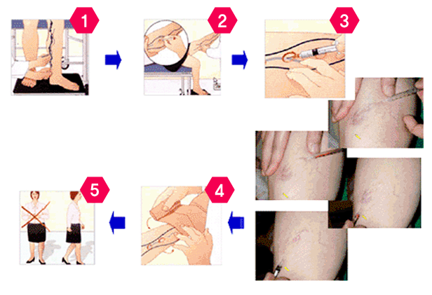 혈관경화요법 시술과정