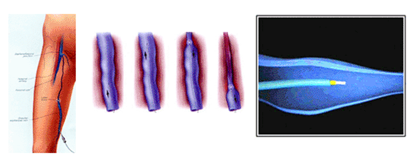 다이오드 레이저 시술